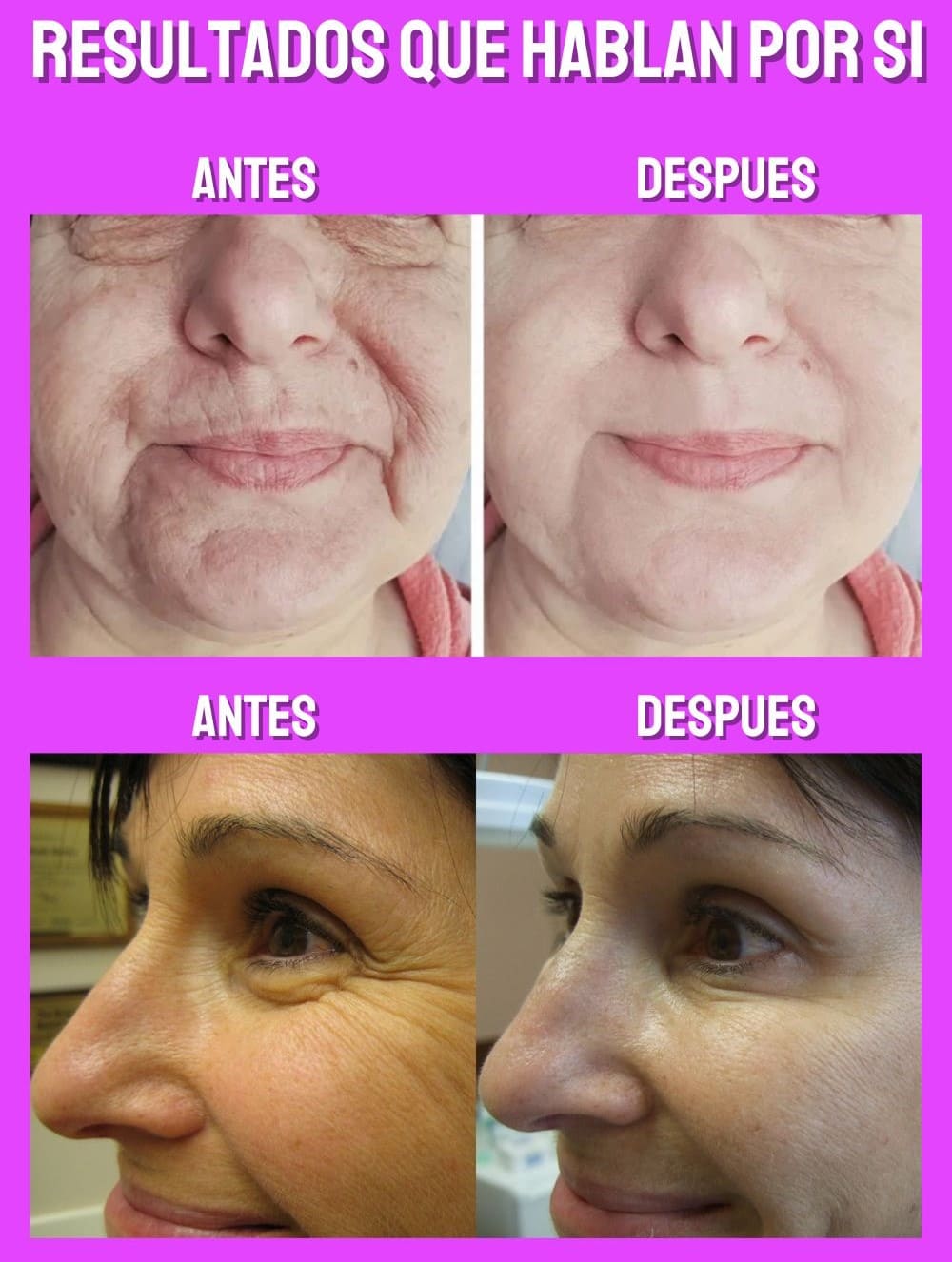 x6 Mascarillas Hidratante Ácido Kójico Limpieza facial Cuidado de la piel